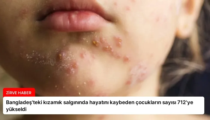 Bangladeş’teki kızamık salgınında hayatını kaybeden çocukların sayısı 712’ye yükseldi